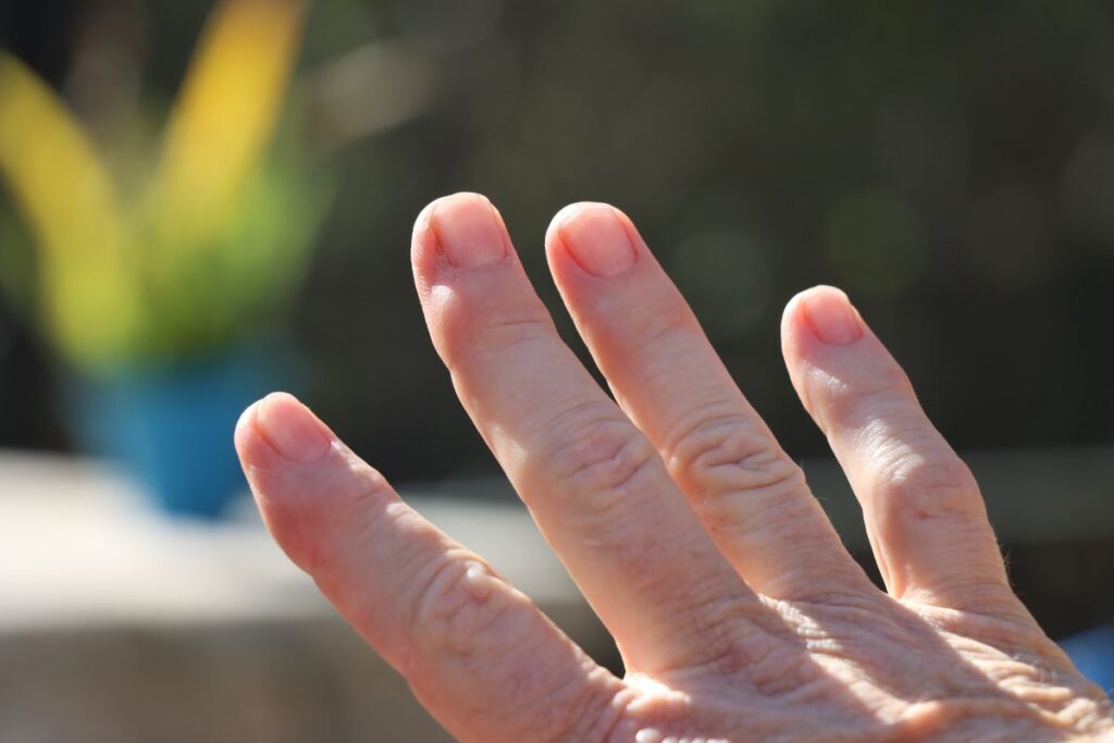artrosi dita della mano - Prof. Matteo Guzzini Chirurgo della Mano